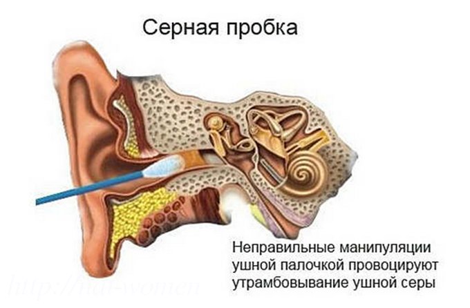 Если в ухе пробка что делать в домашних условиях Если в ухе пробка что делать в домашних условиях