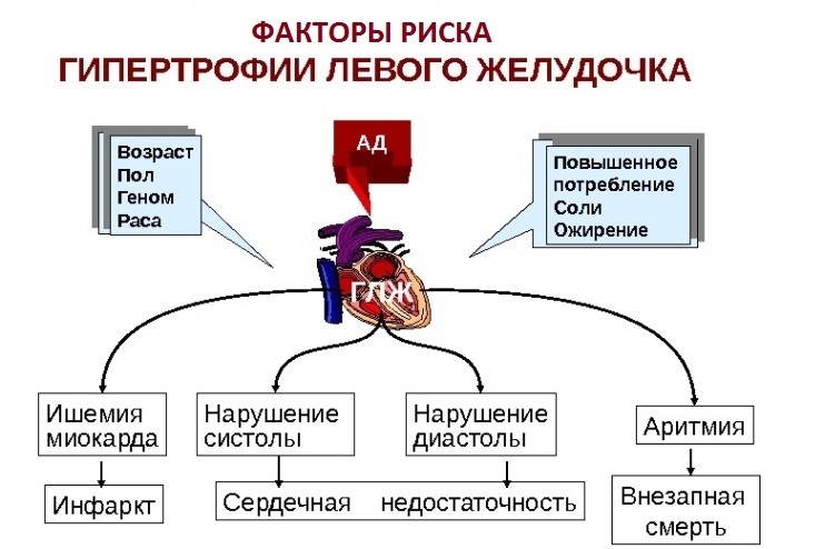 Лечение народными средствами гипертрофия миокарда левого желудочка лечение thumbnail
