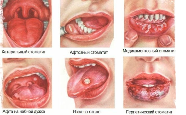 Стоматит у детей лечение в украине